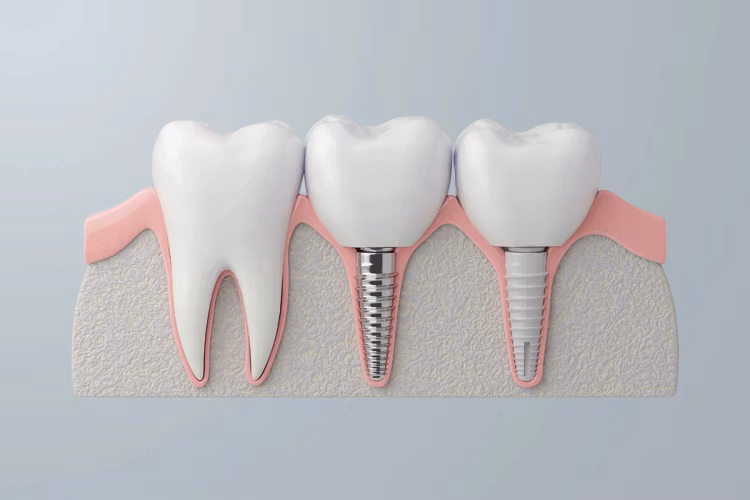 Dental Implant